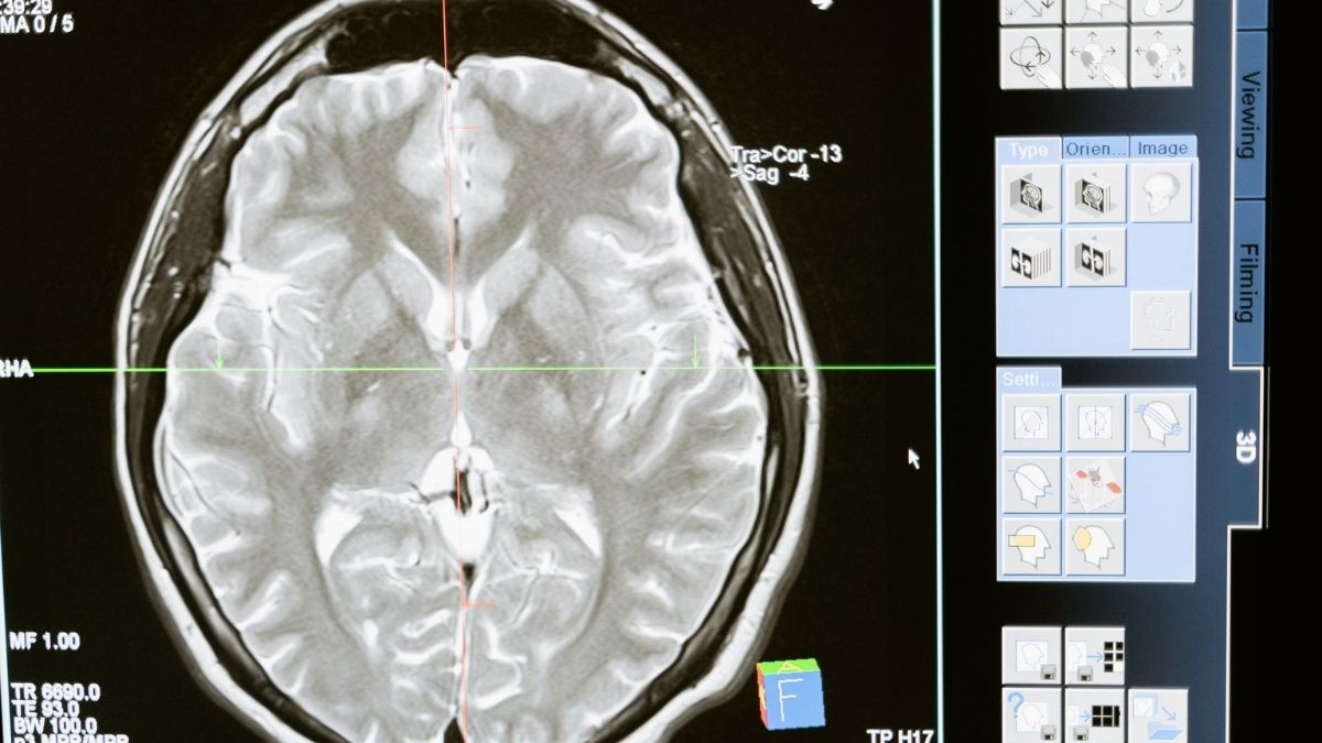 MRI brain scan illustrating neurological differences linked to autistic inertia, motivation, and executive functioning. MRI brain scan illustrating neurological differences linked to autistic inertia, motivation, and executive functioning.